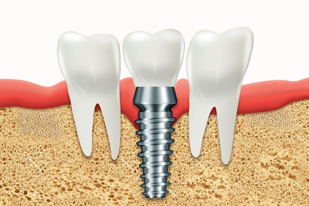 Are Dental Implants Worth It? | Best Dental
