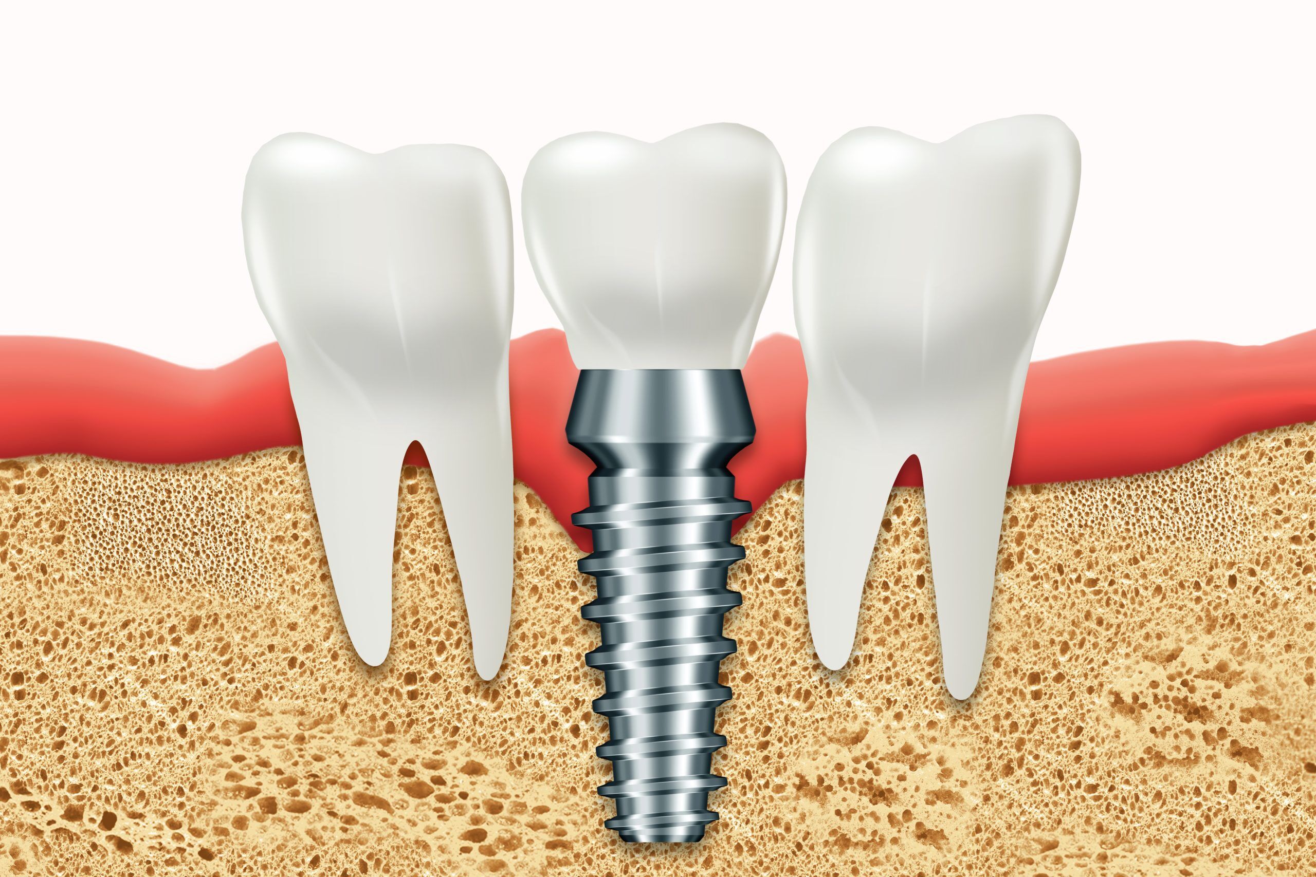 Long-term Value of Dental Implants: Why They’re Worth the Investment