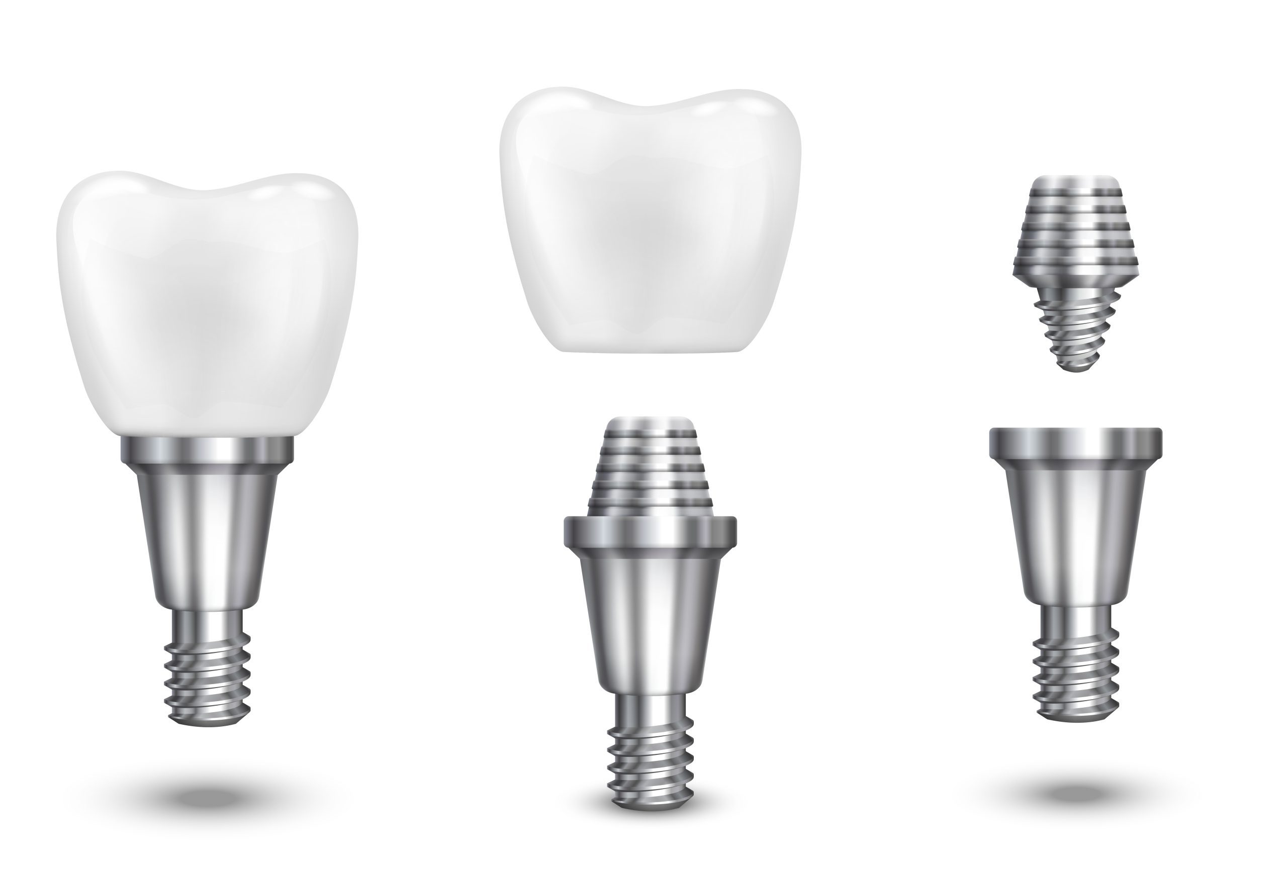 Affordable Dental Implants Sugar Land, TX Best Dental
