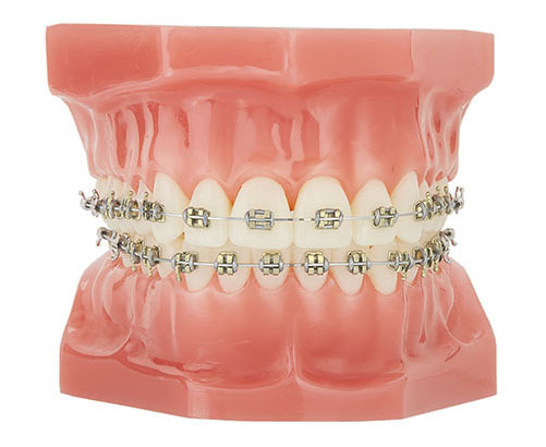 Gold Braces | Best Dental