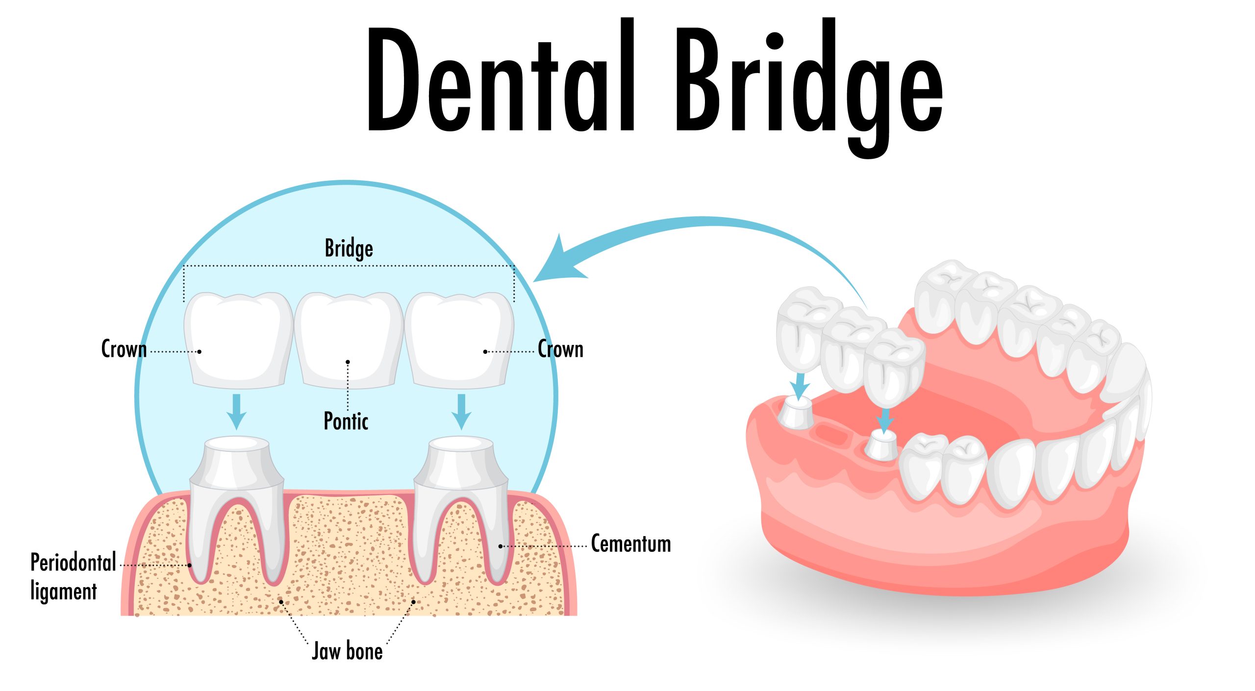 Dental Bridges Katy, TX | Best Dental