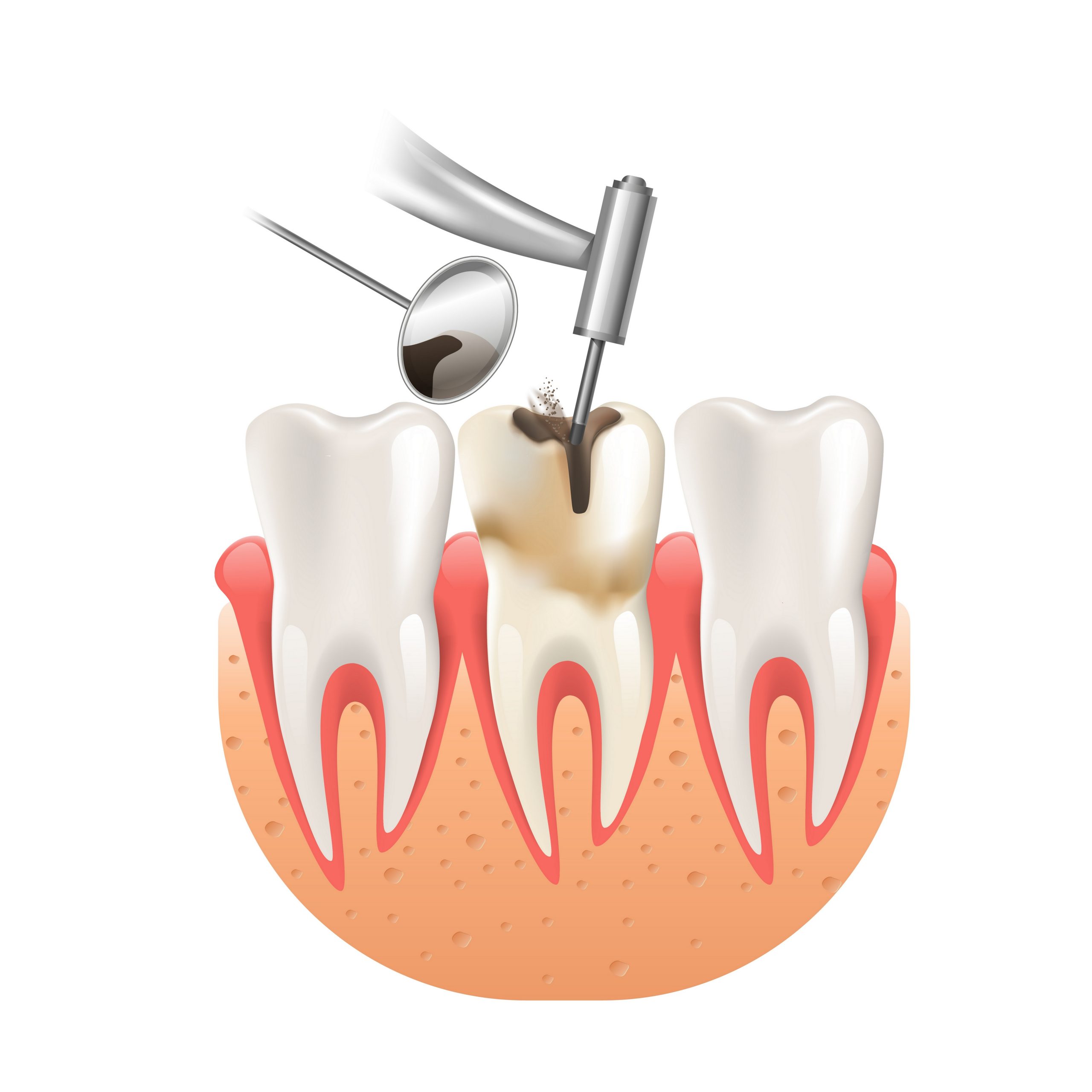 Emergency Root Canal Houston, TX Best Dental