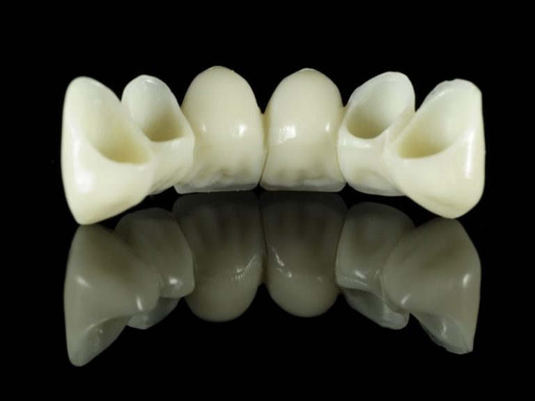 6 unit canine to canine bridge cost | Best Dental