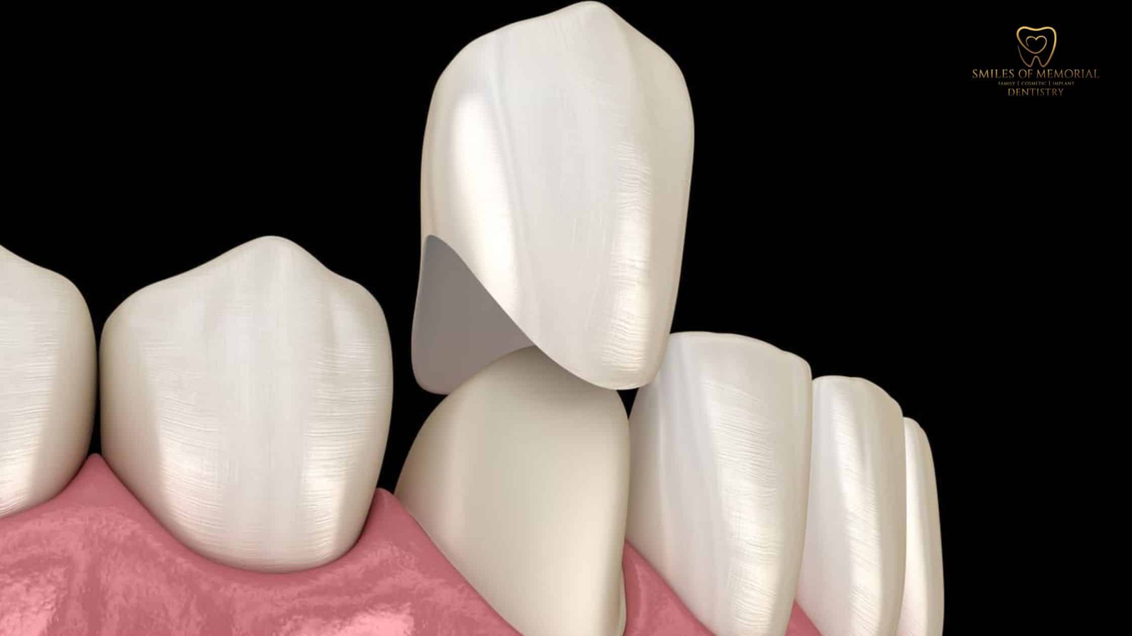 What is a dental crown | Best Dental in Houston, TX
