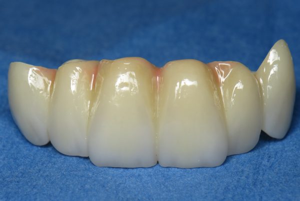 6 unit canine to canine bridge cost | Best Dental