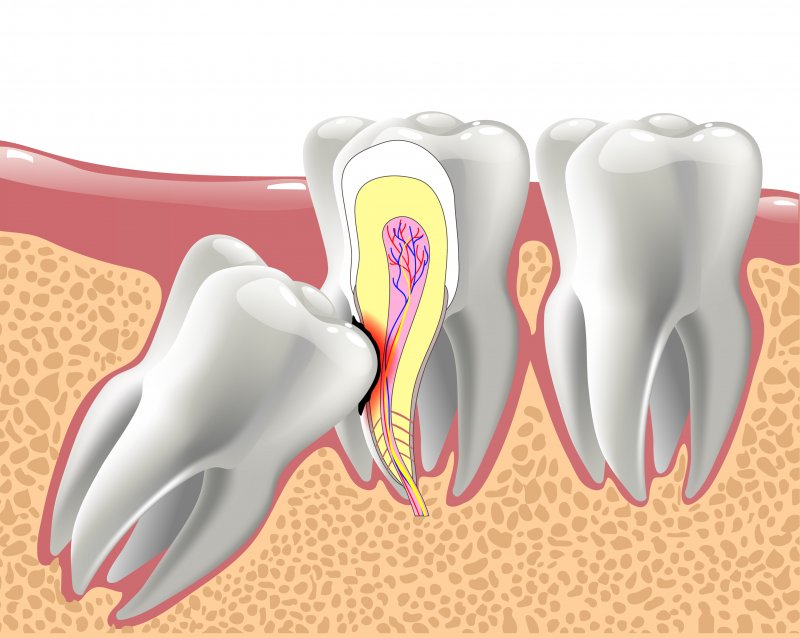 Full Bony Impacted Wisdom Teeth | Best Dental