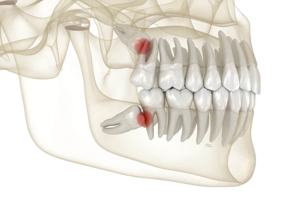 Does Your Wisdom Tooth Have A Sharp Edge? Best Dental