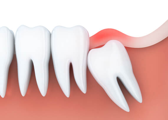 Wisdom Teeth Removal Houston, TX | Best Dental