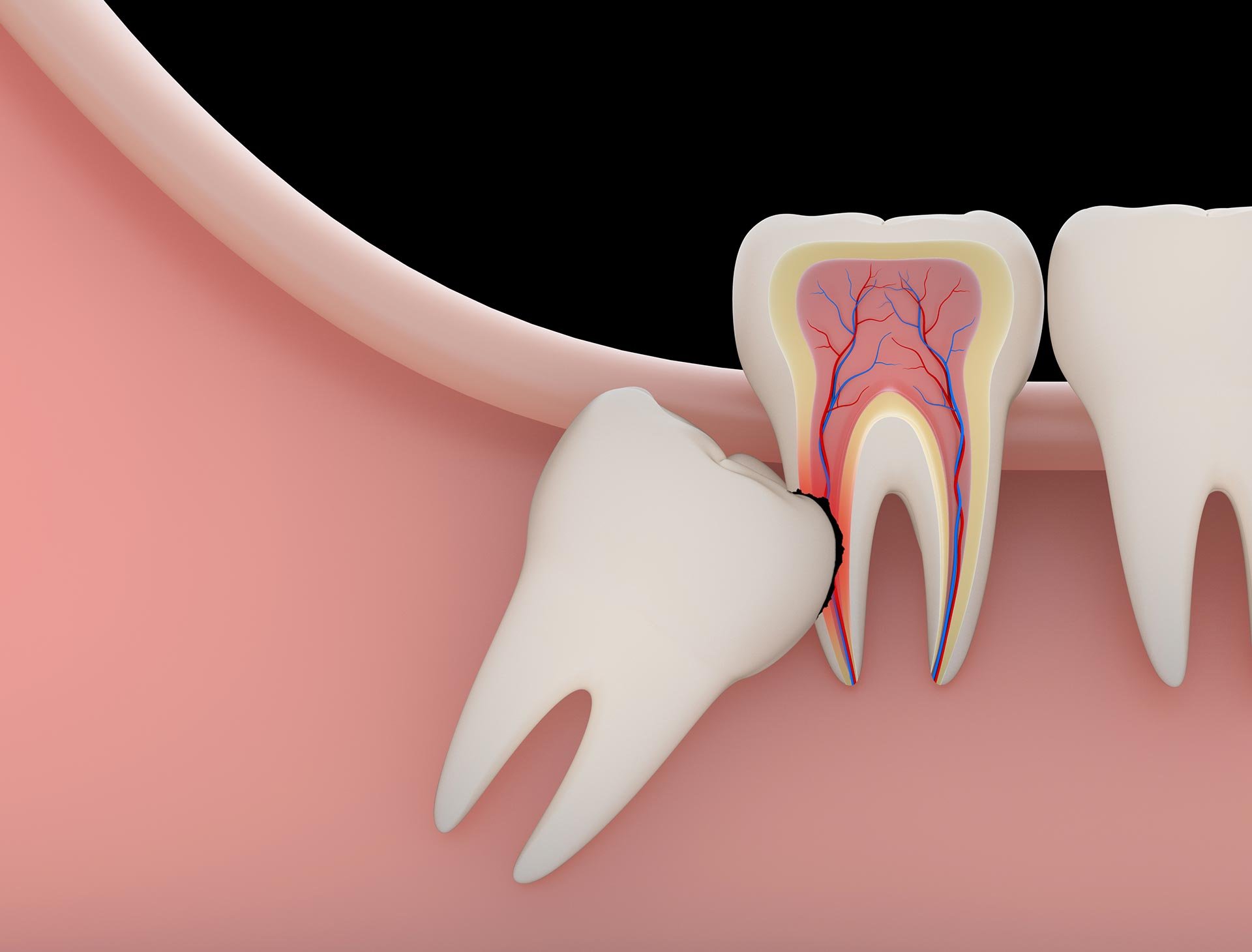Wisdom Teeth Removal Houston, TX | Best Dental