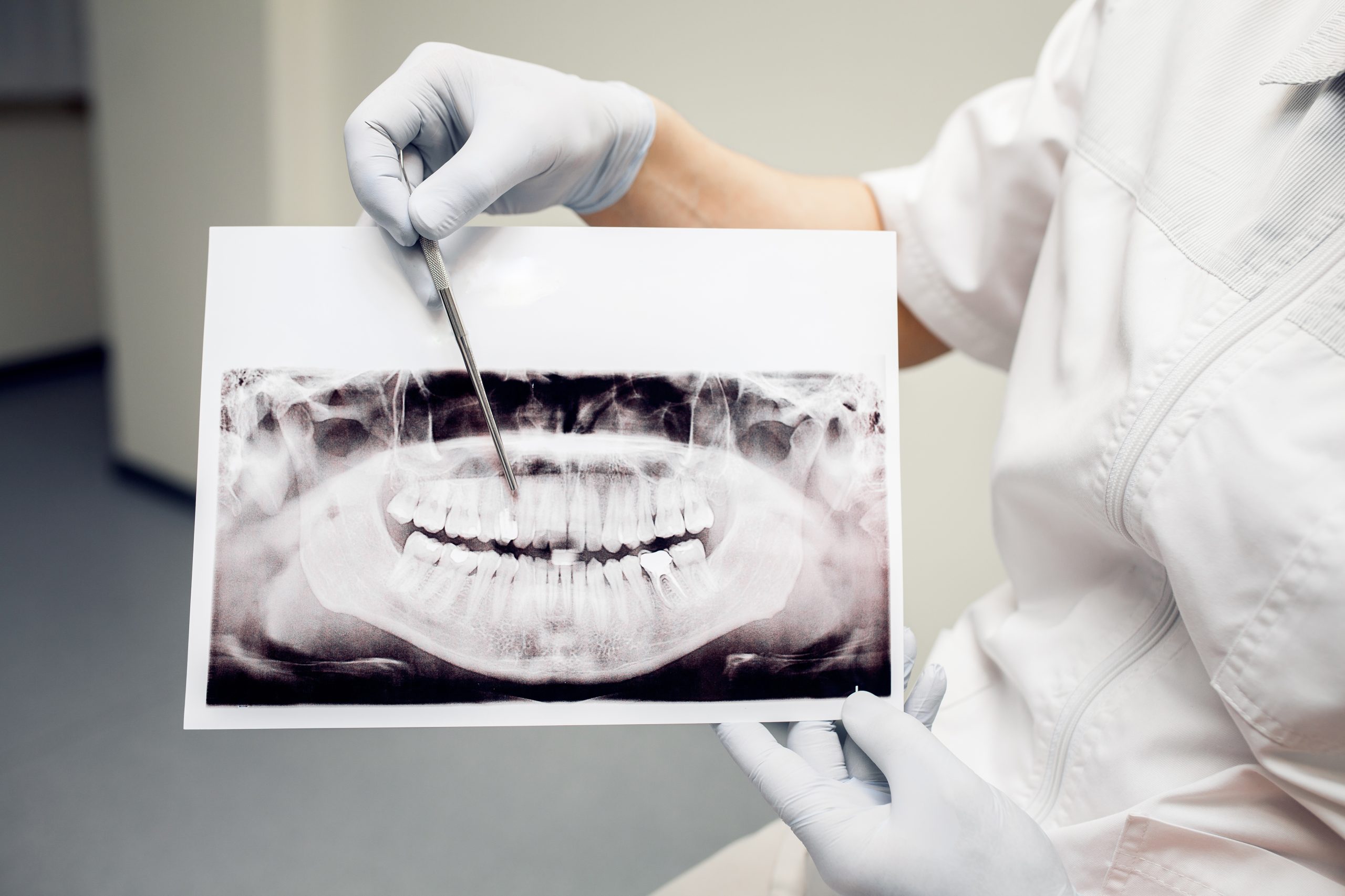 Bone Graft Houston, TX | Best Dental
