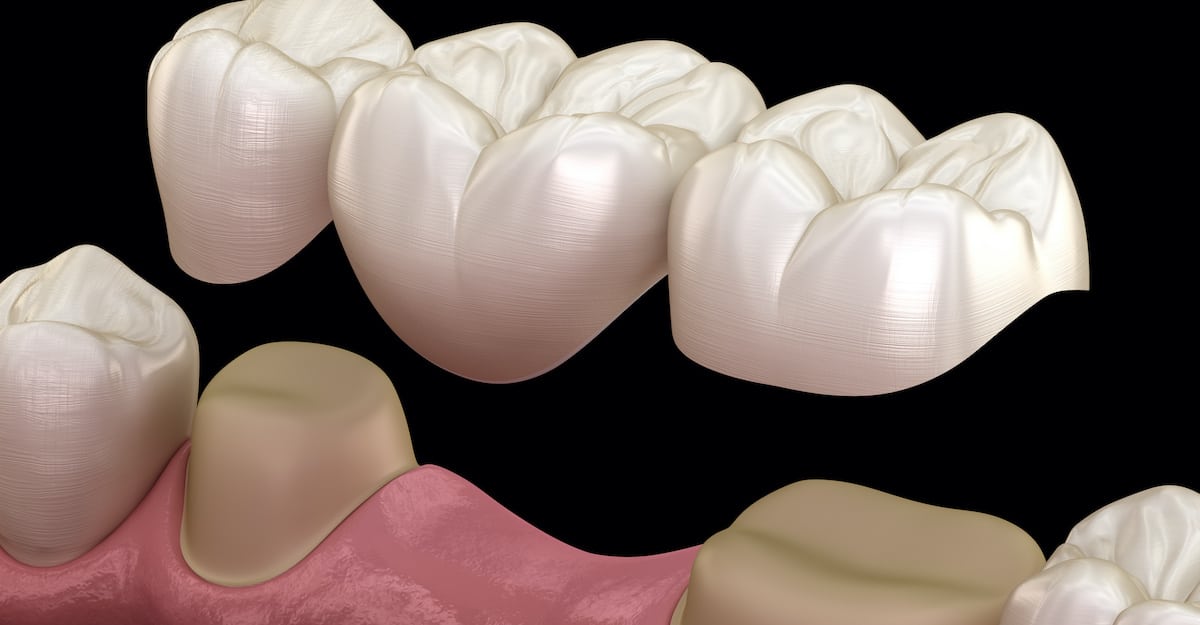 Dental Bridges Richmond, TX | Best Dental