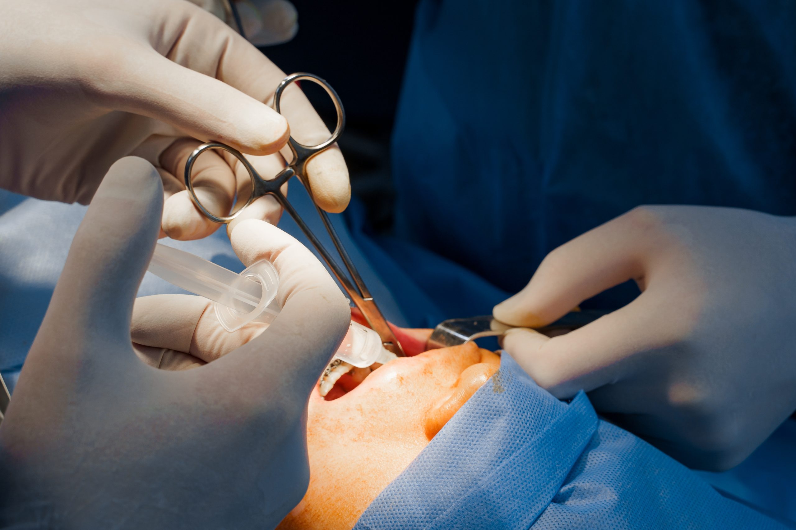 Tooth Extraction Houston, TX | Best Dental