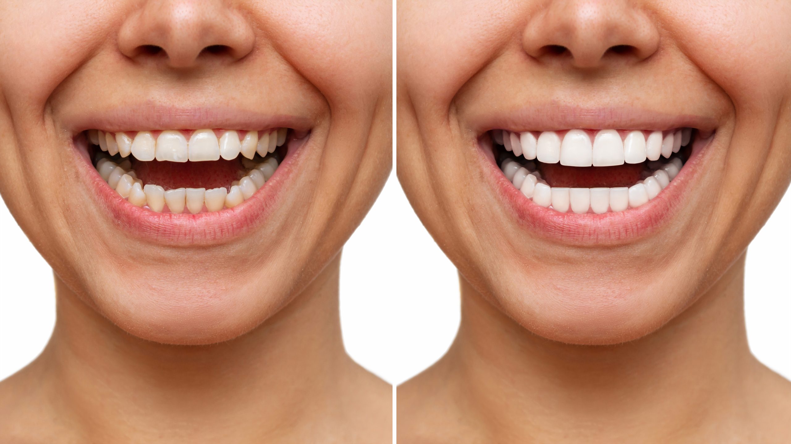 Dental Veneers Richmond, TX | Best Dental