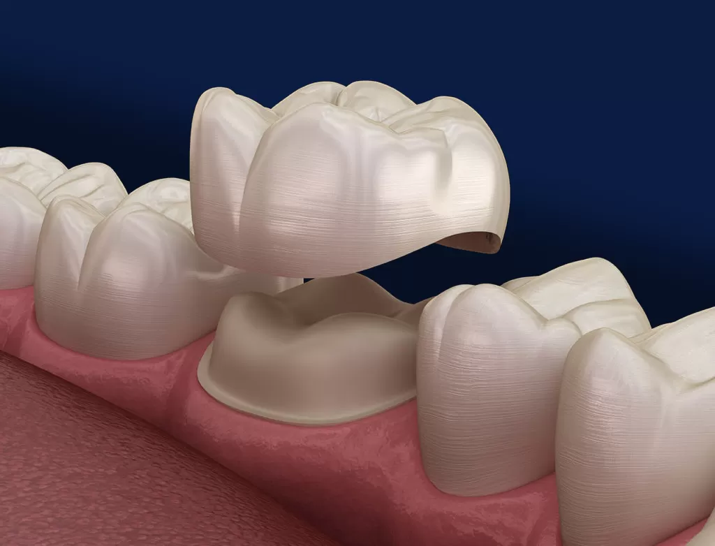 What Is A Dental Crown?