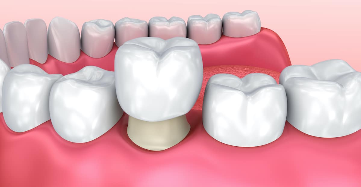 What is a dental crown | Best Dental in Houston, TX