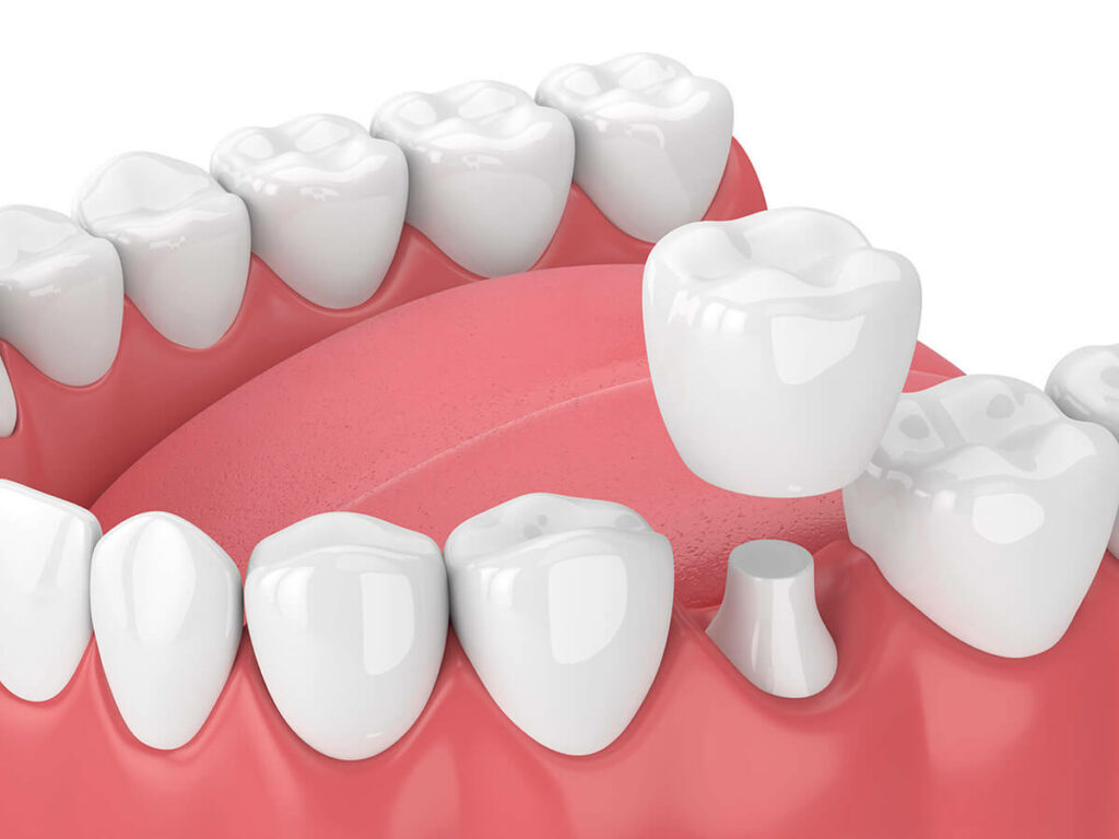 What is a dental crown | Best Dental in Houston, TX