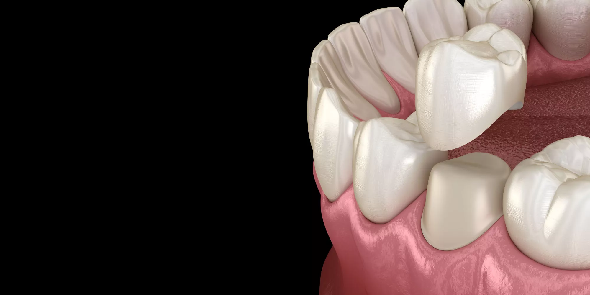 What Is A Dental Crown?