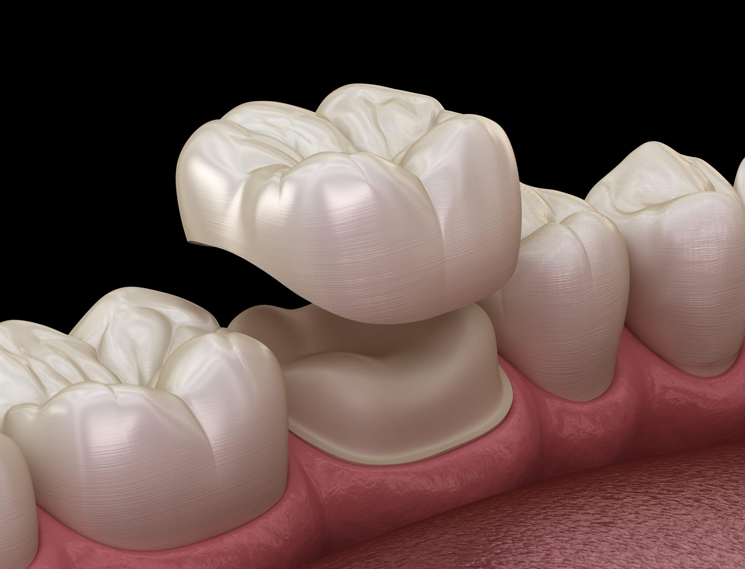 What is a dental crown | Best Dental in Houston, TX