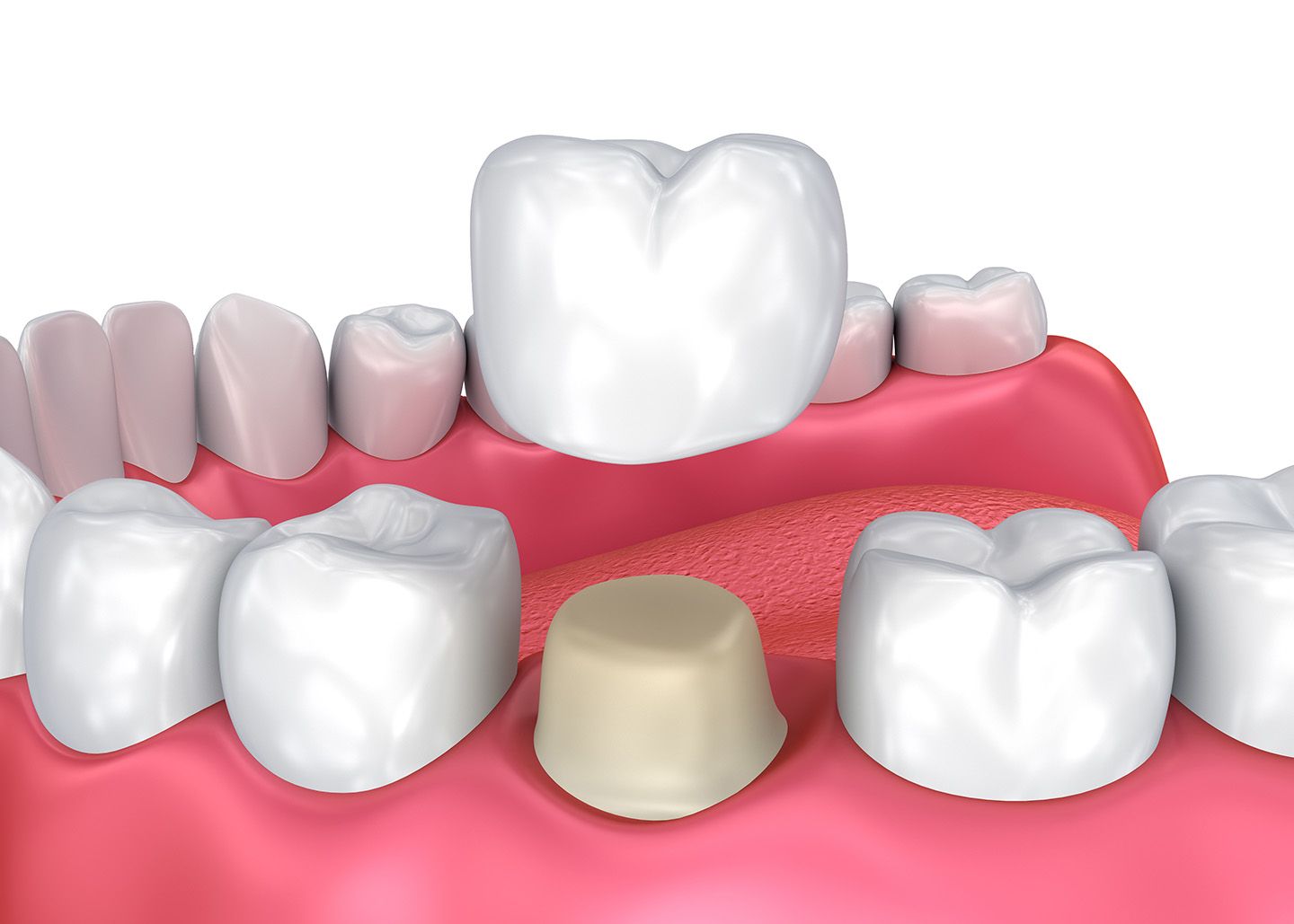 What is a dental crown | Best Dental in Houston, TX