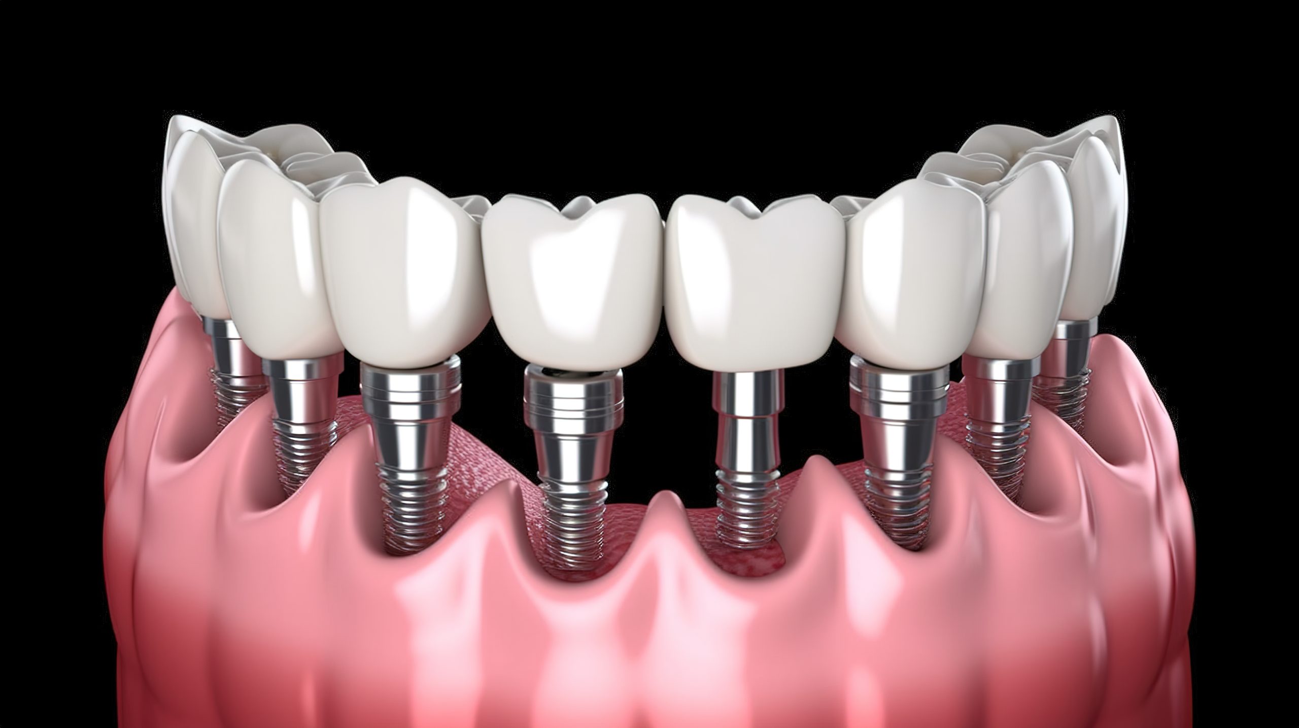 How are Dental Implants Removed?