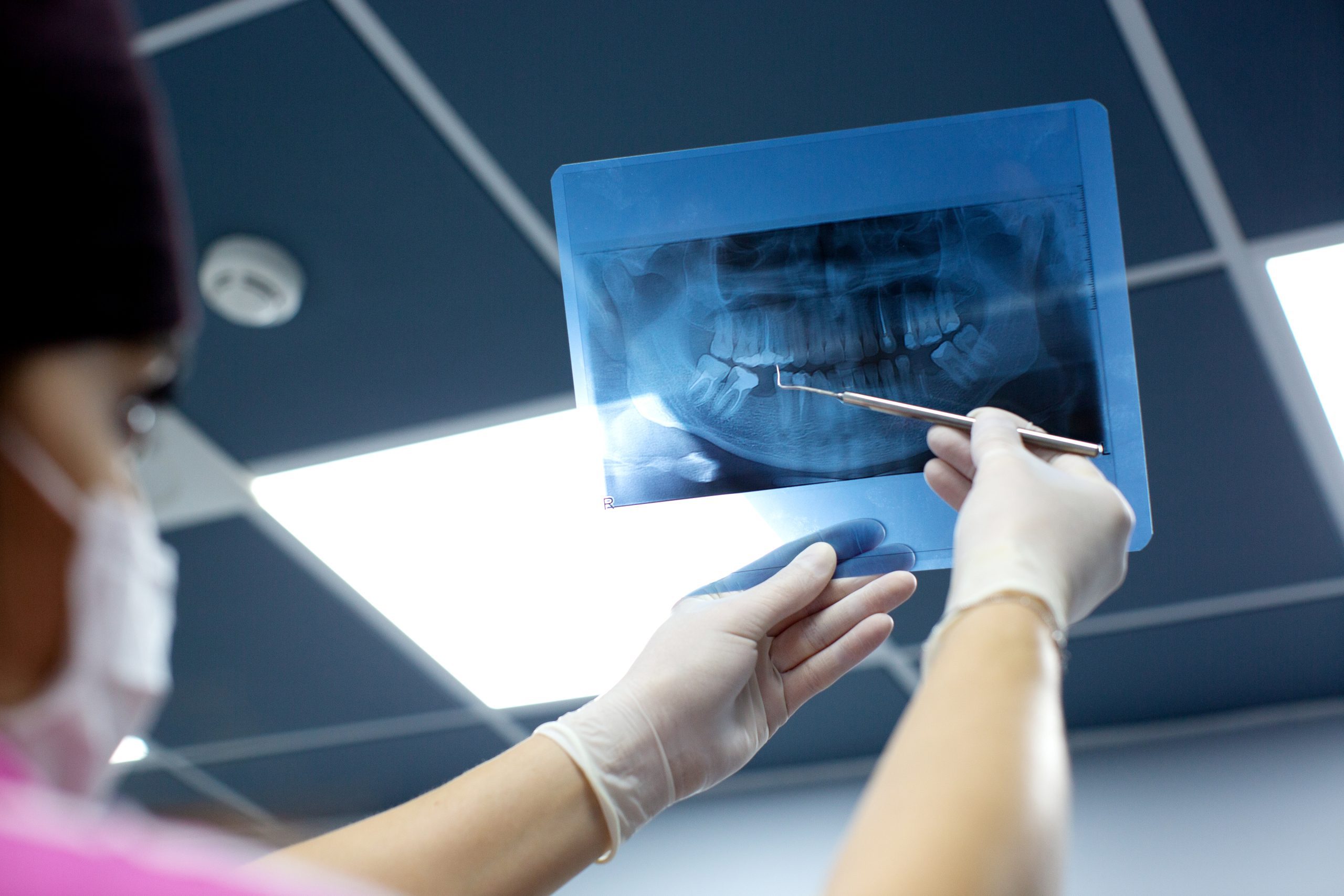 Bone Graft Houston, TX | Best Dental