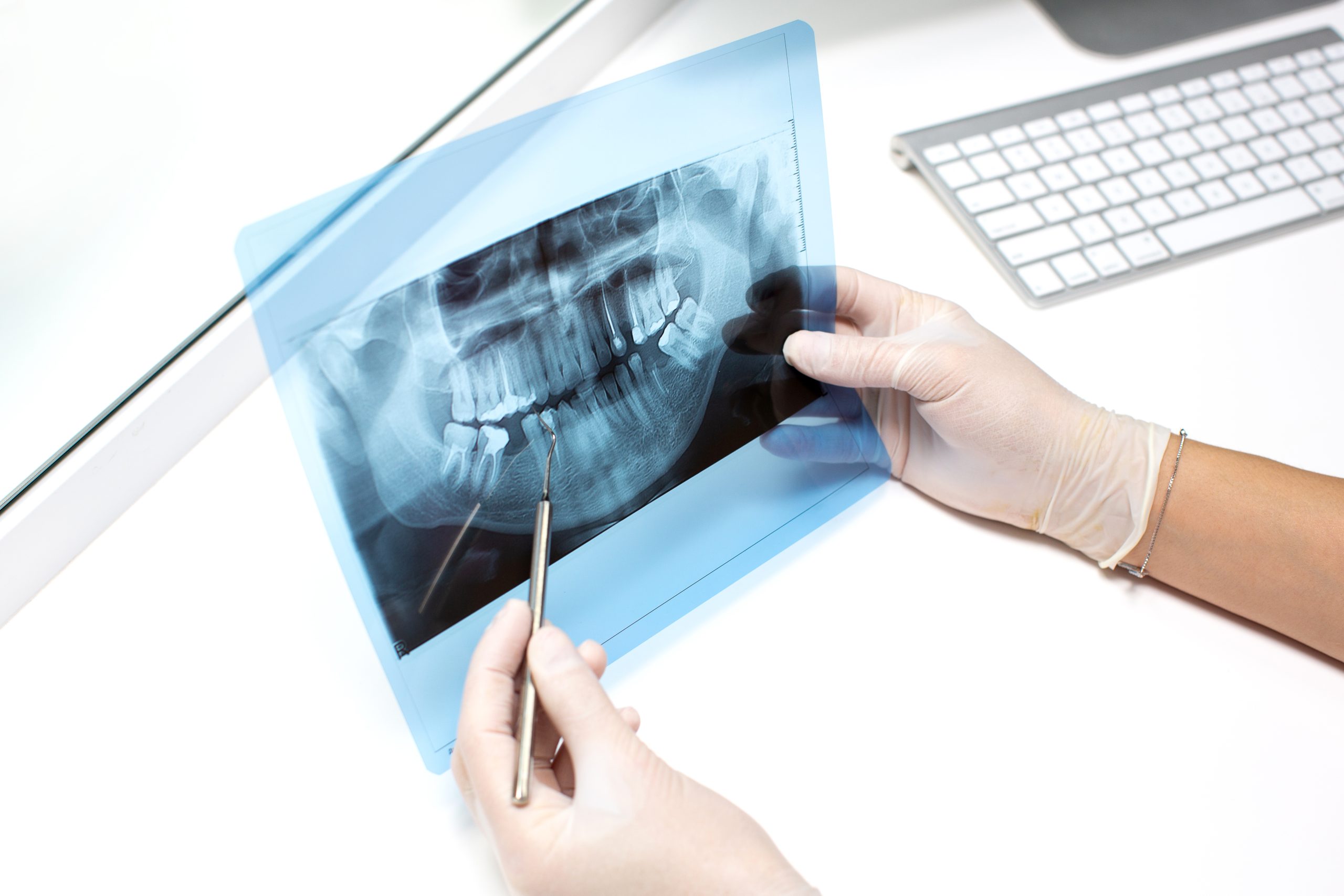 Bone Graft Houston, TX | Best Dental