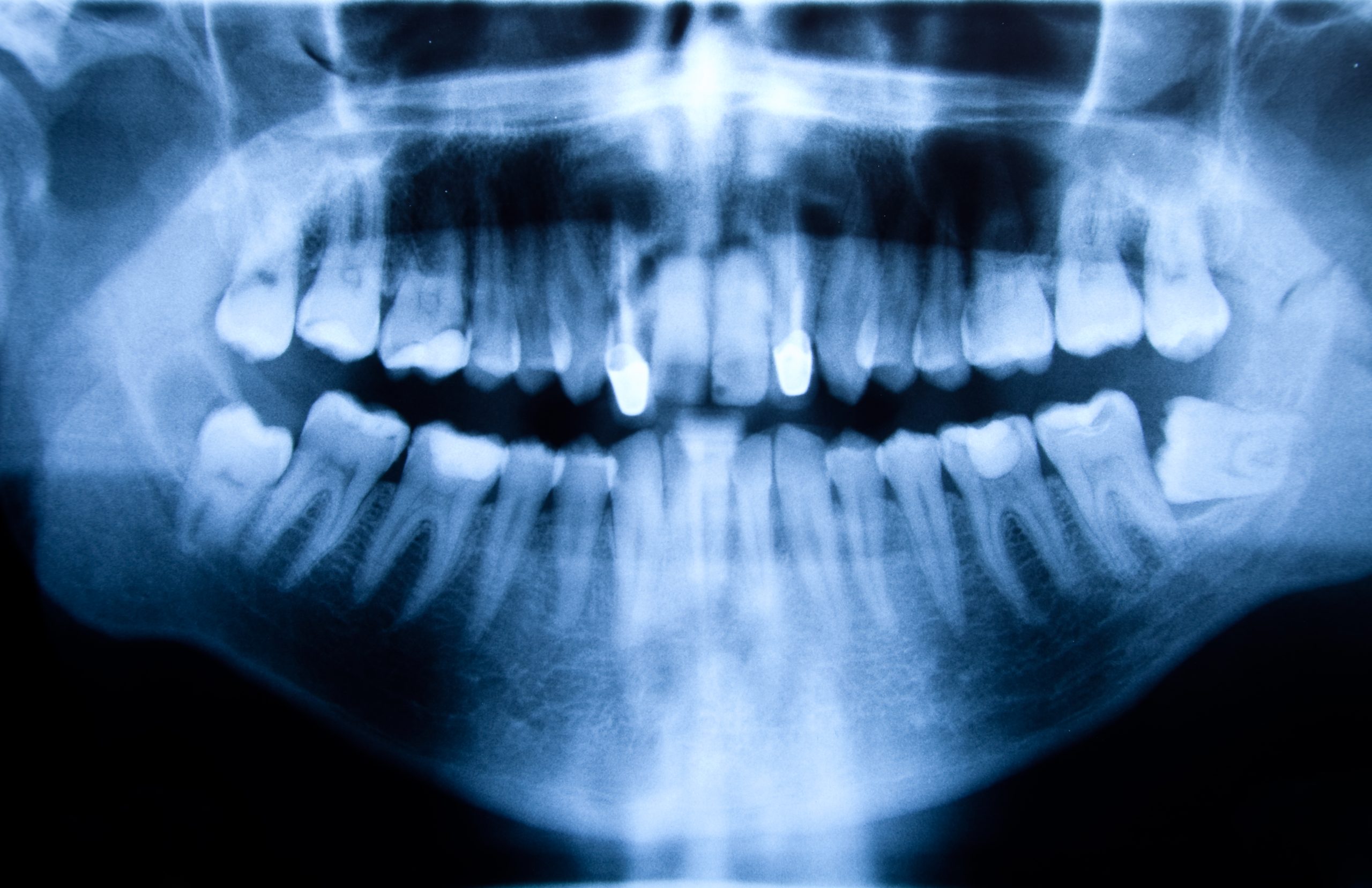 Dental Xrays Richmond, TX Best Dental
