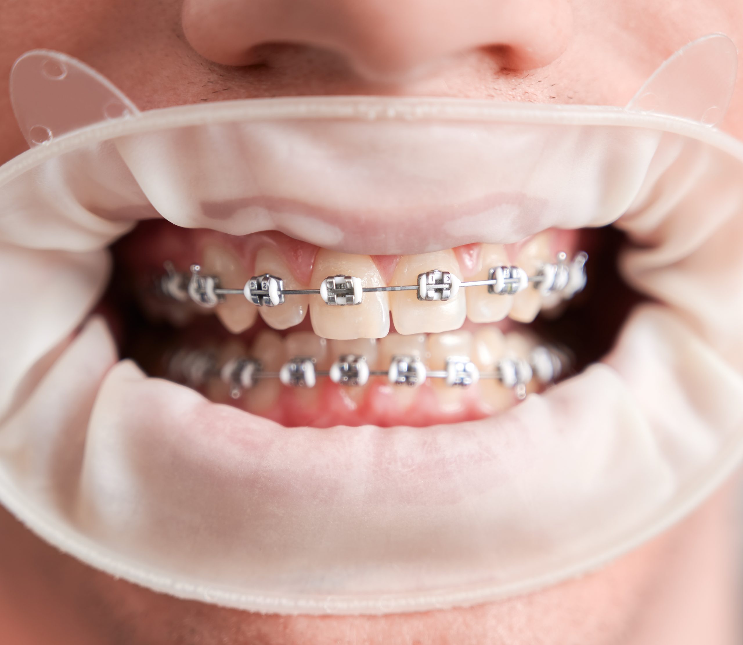 Dental Braces Richmond, TX | Best Dental