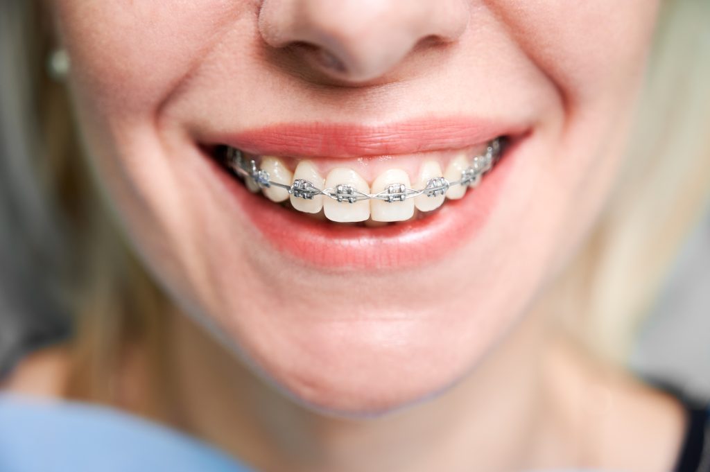 Gray Braces An Overview Best Dental