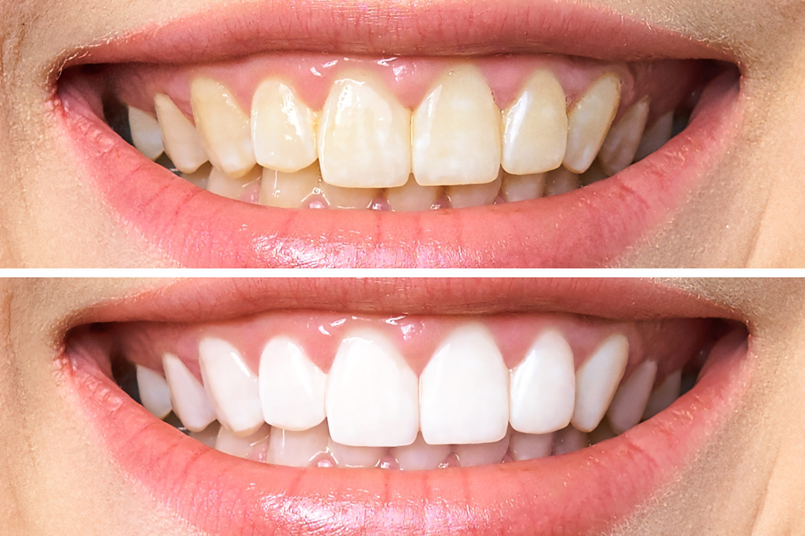 E-Max Dental Veneers | Best Dental
