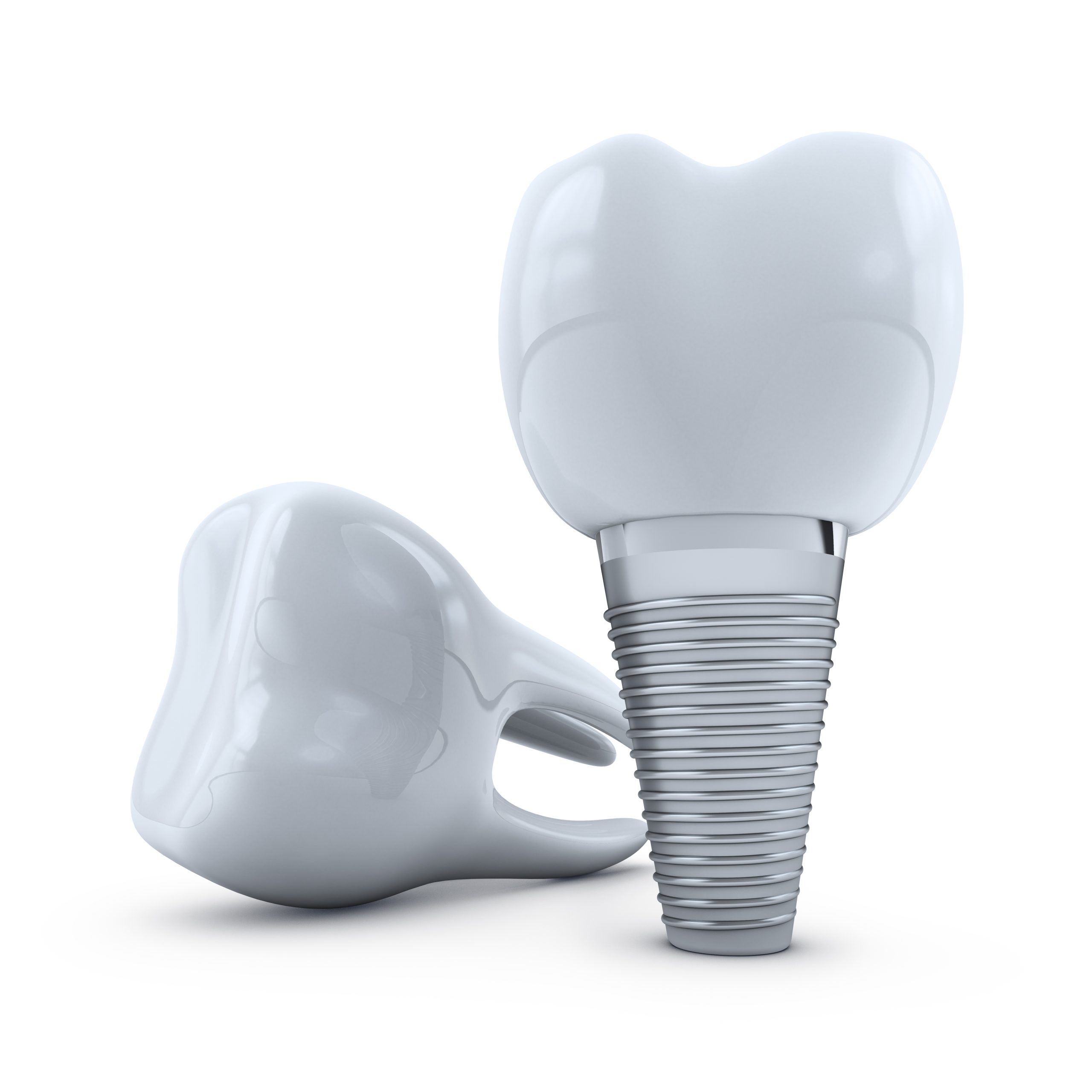 The Cost Of A Single Tooth Dental Implant In Texas – An Overview
