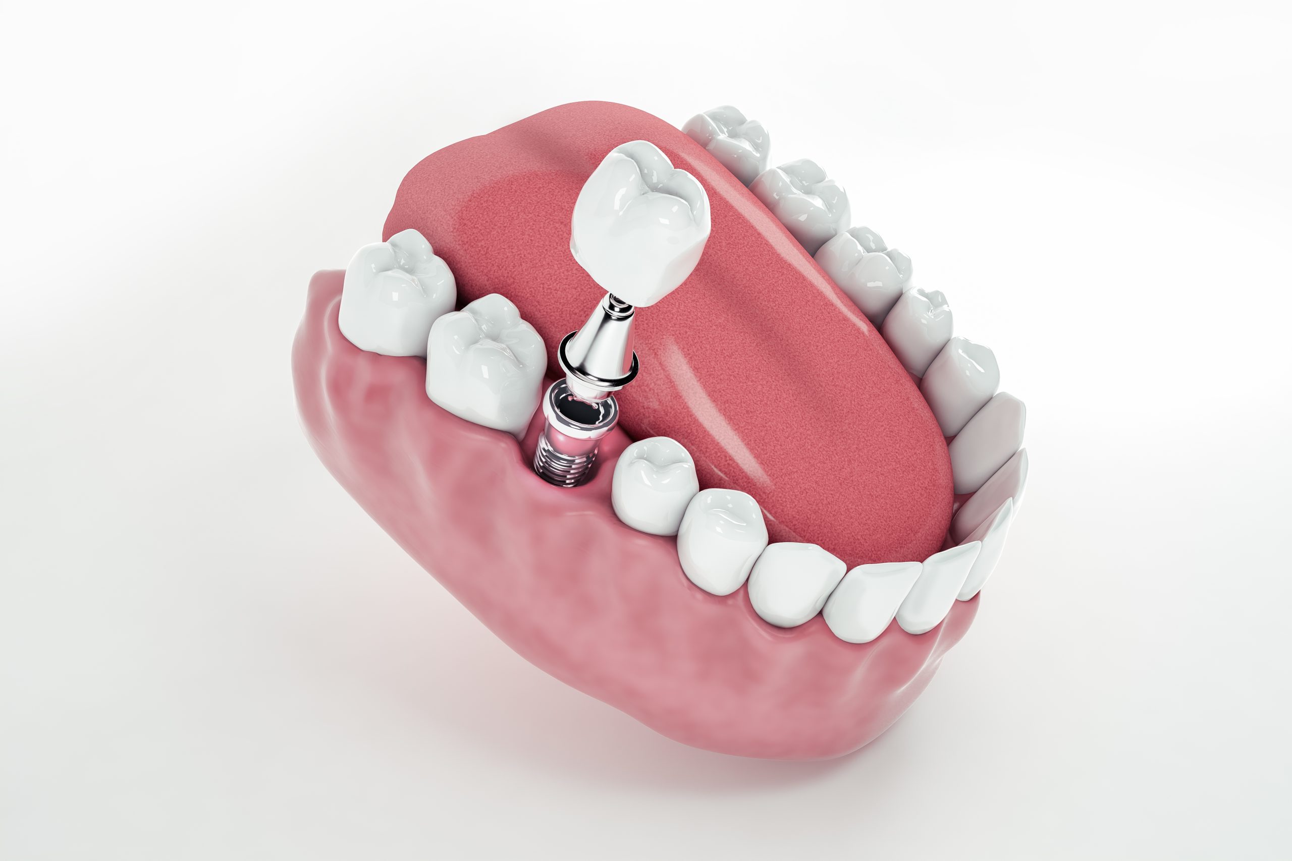 Dental Implant Healing Caps | Best Dental