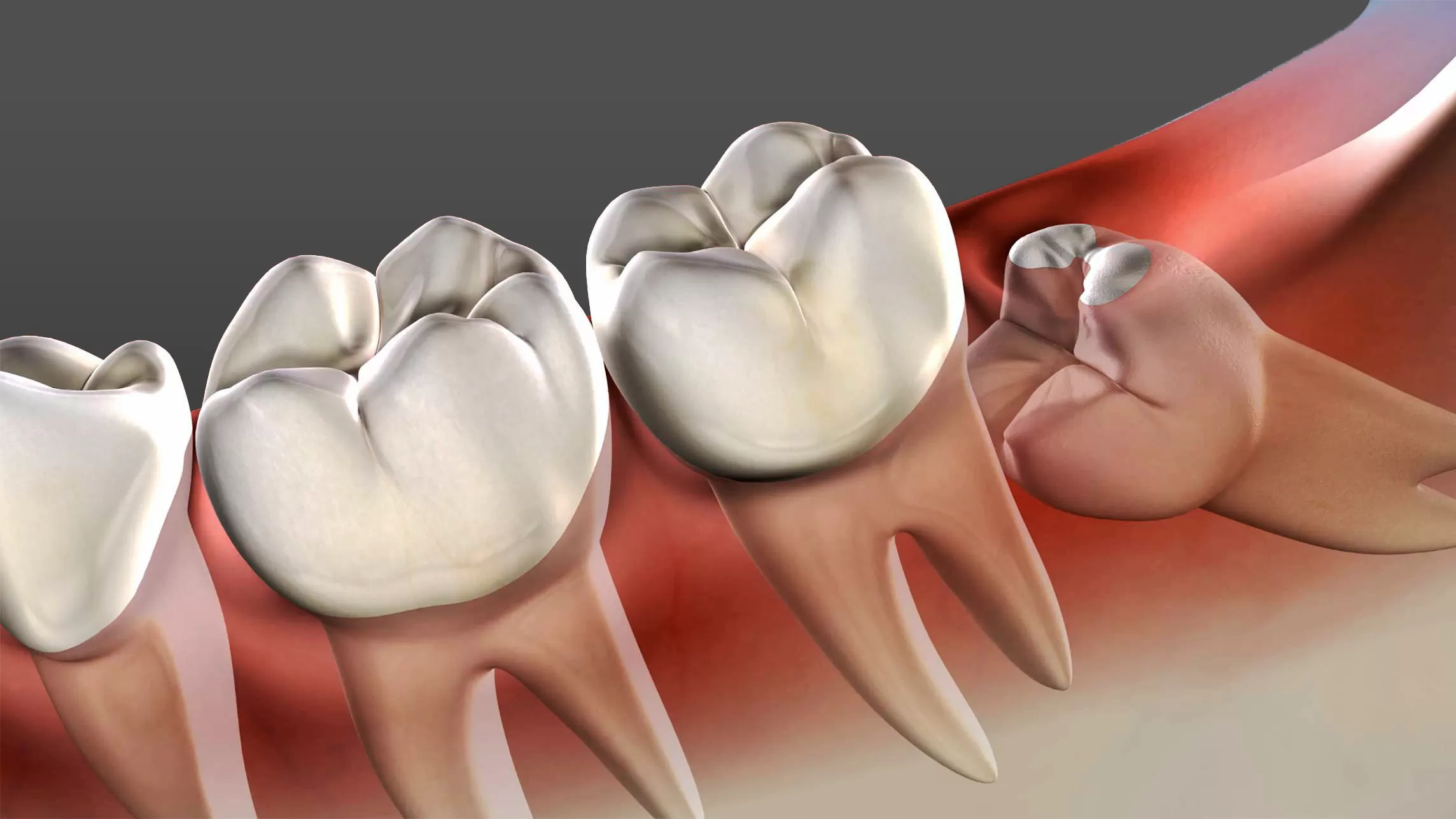 Wisdom Teeth Removal Houston, TX | Best Dental