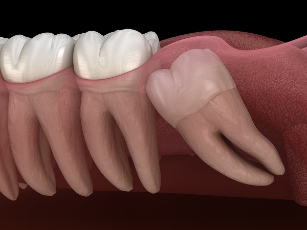 Wisdom Teeth Removal Houston, TX | Best Dental