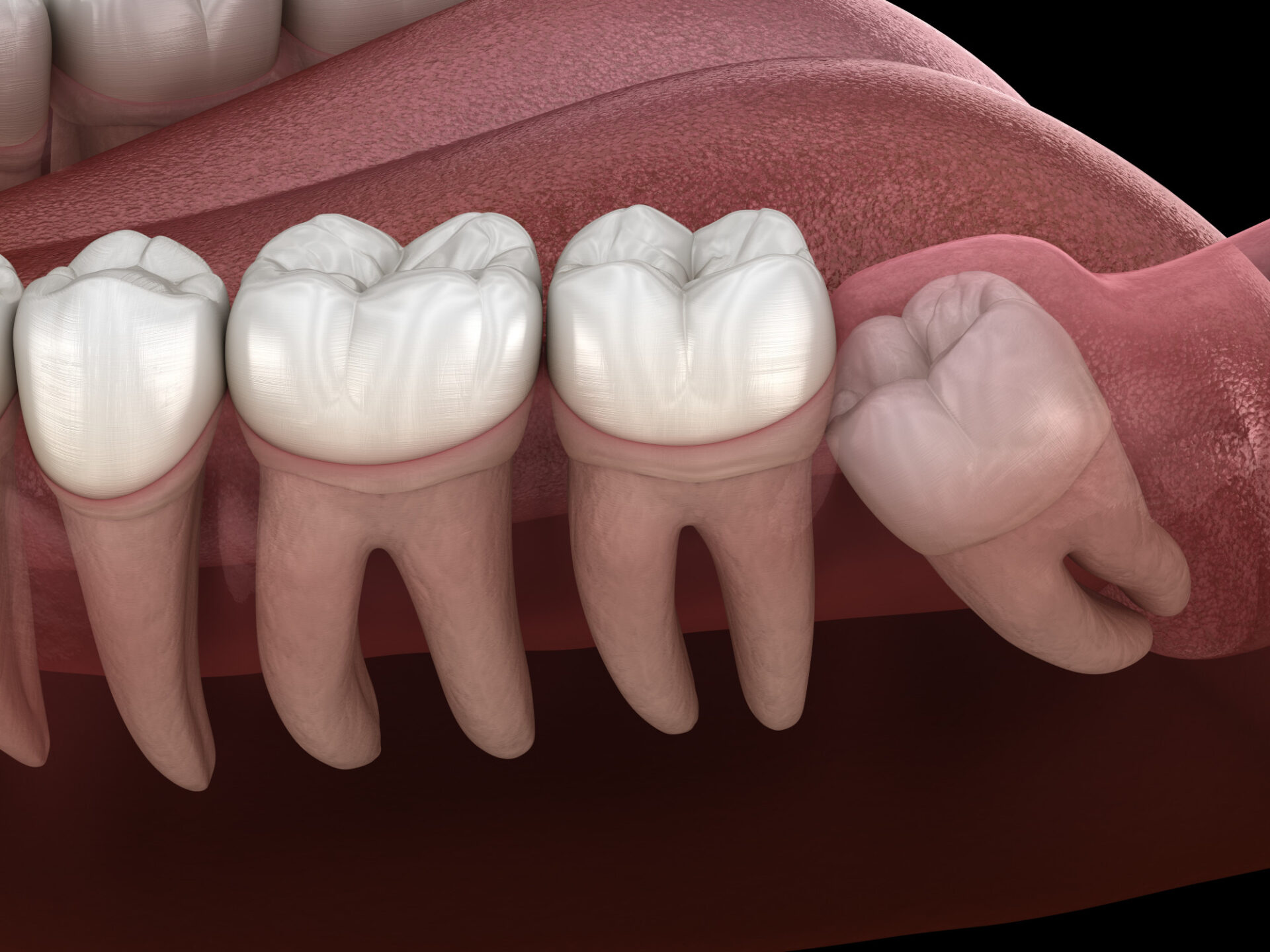 Wisdom Teeth Removal Richmond, TX | Best Dental