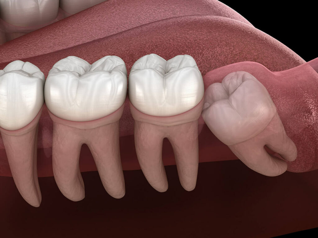 Wisdom Teeth Removal Houston, TX | Best Dental