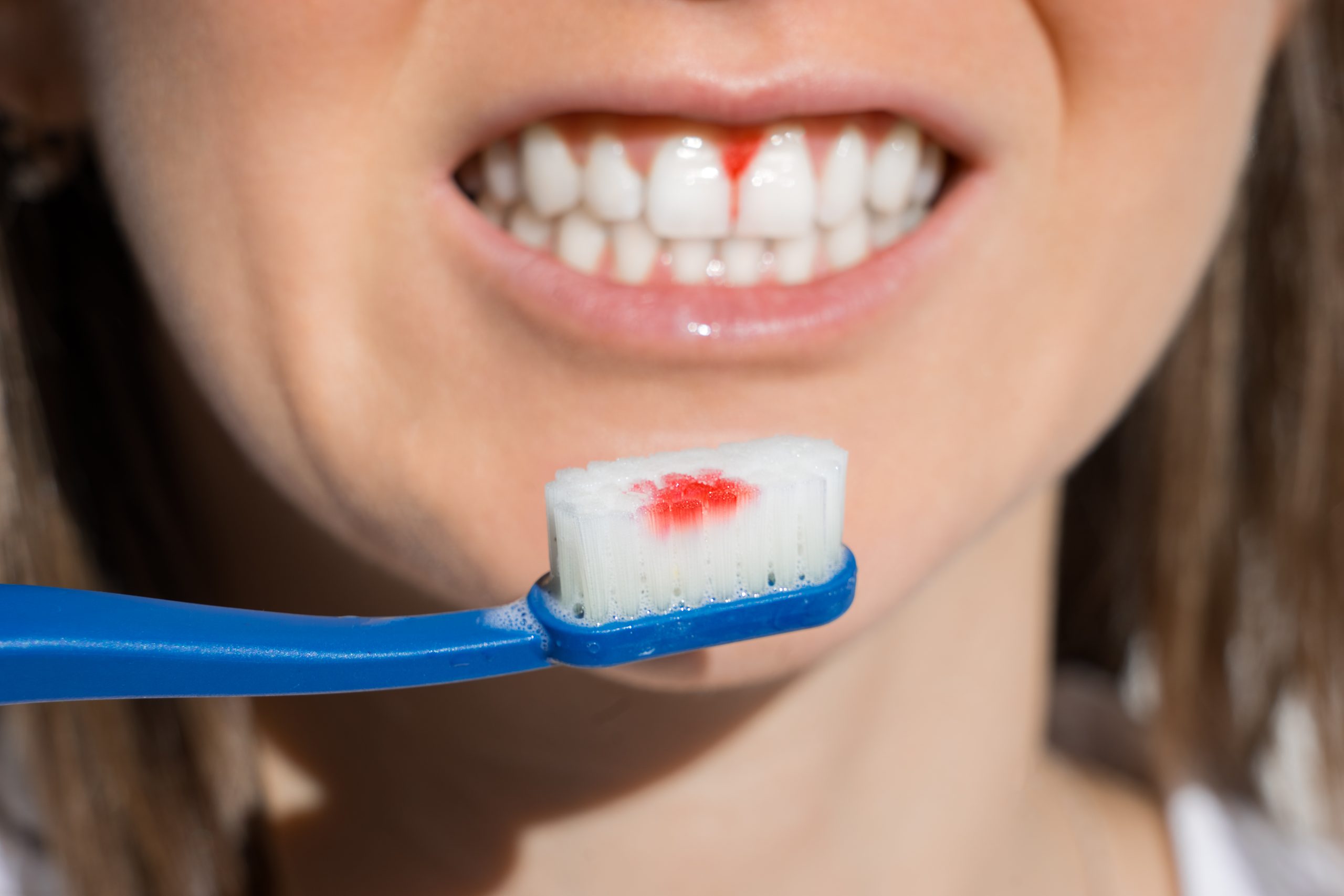 Scaling and Root Planing Houston, TX | Gum Disease Treatment