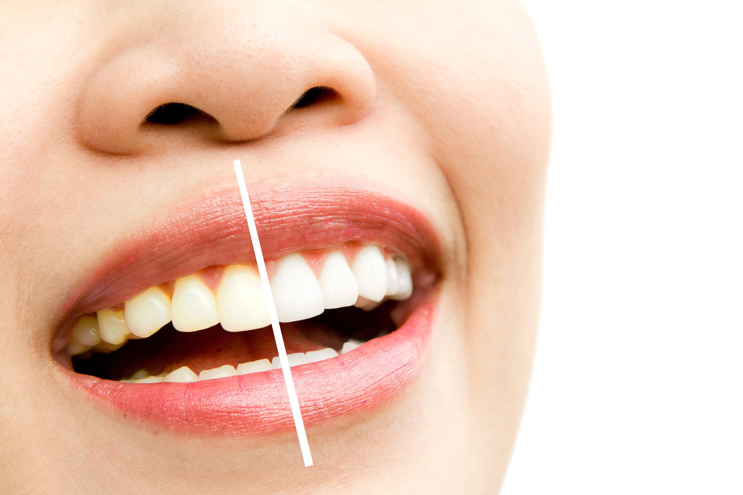 Teeth Whitening Houston, TX Best Dental