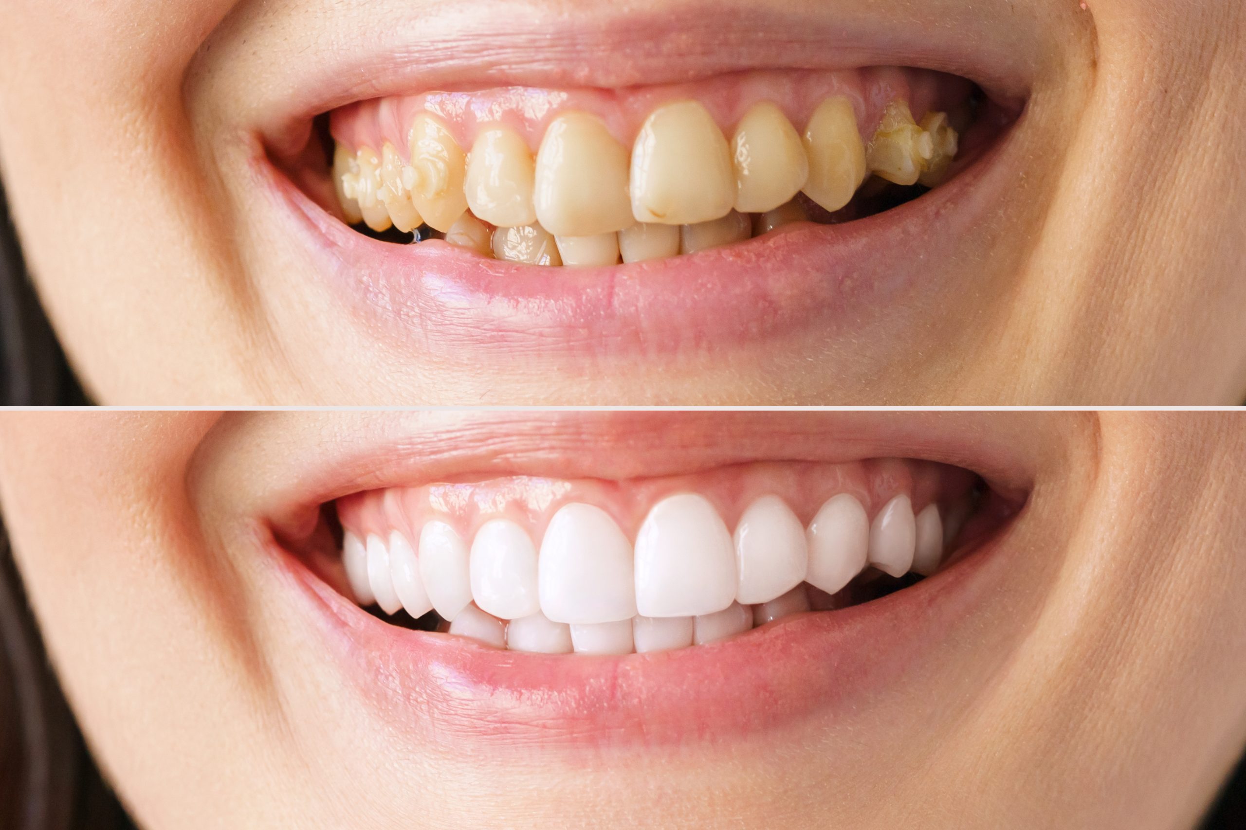 Dental Veneers Financing & Payment Plan Options In Houston, TX Best