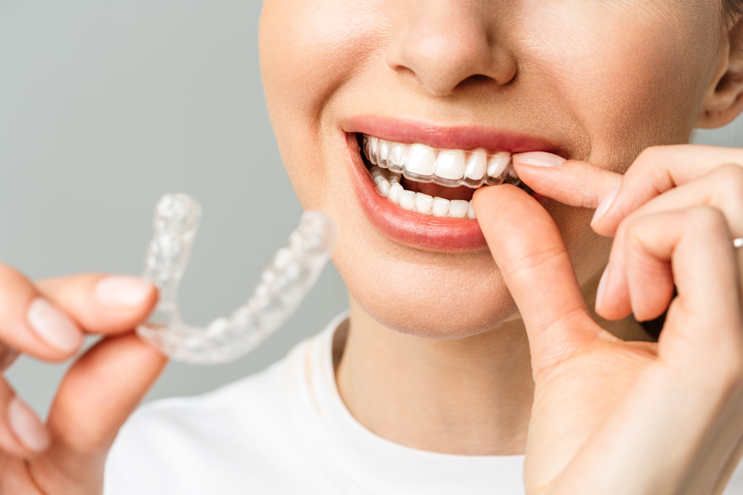 Should I Get Invisalign | Best Dental