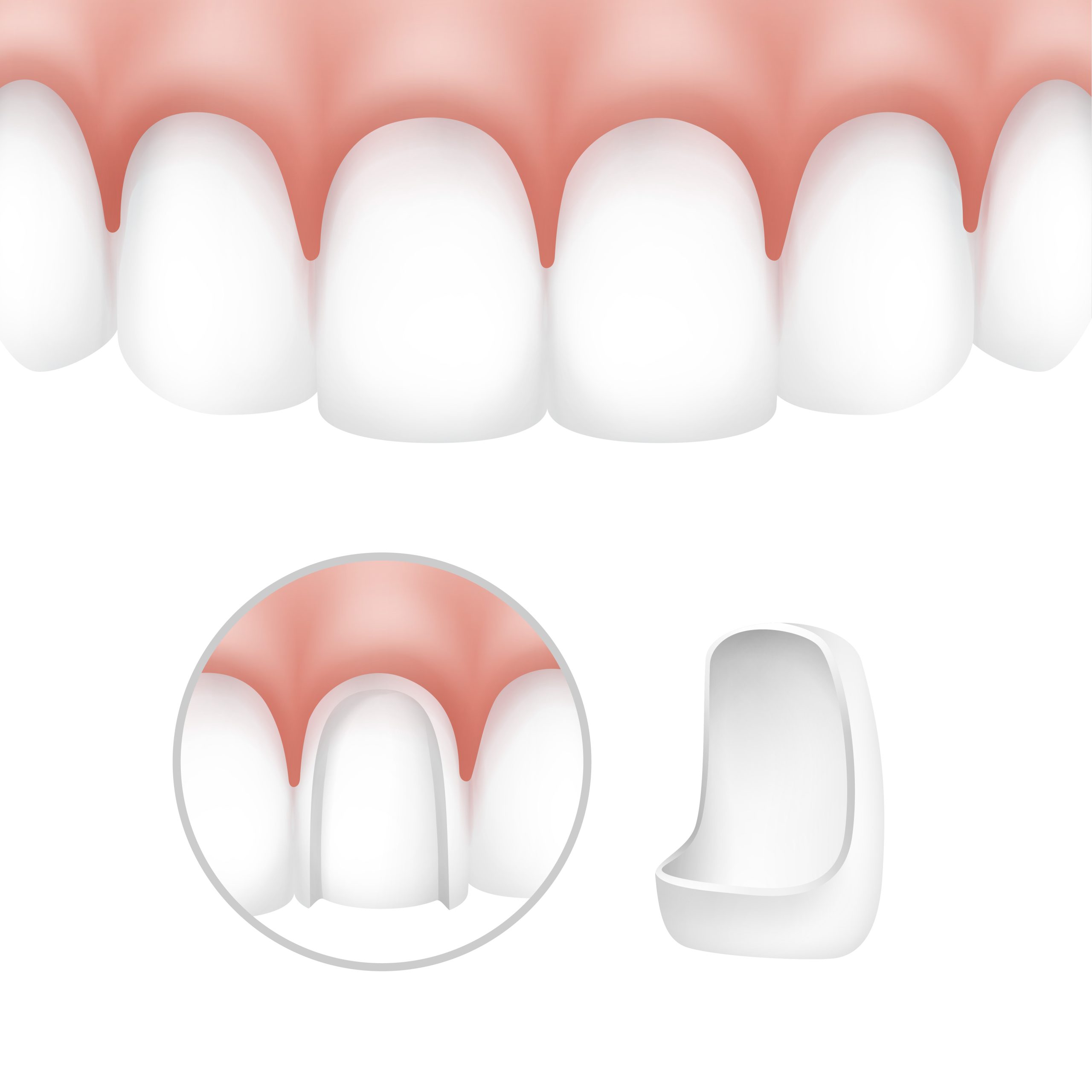 Peg Lateral Teeth | Best Dental