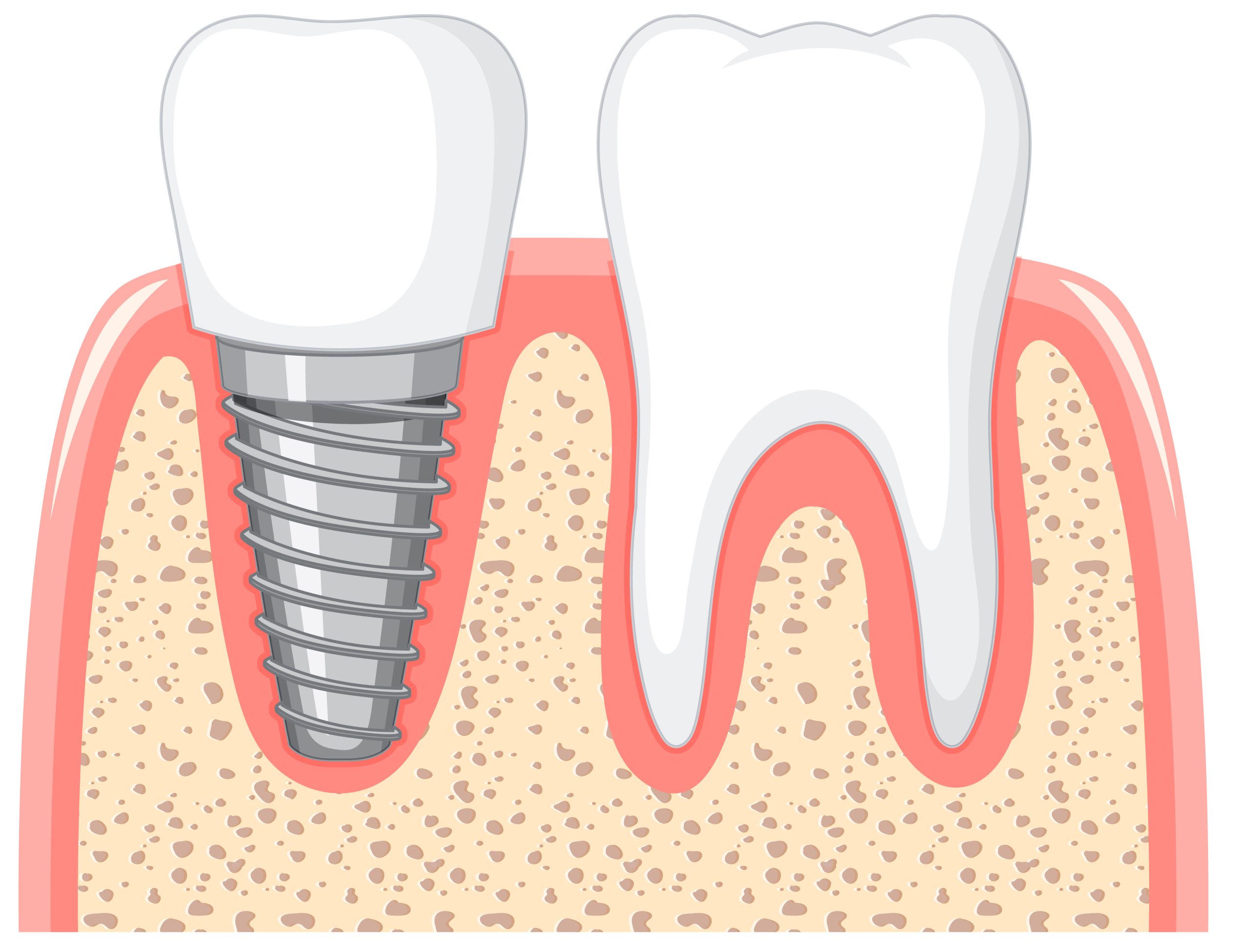 Can Dental Implants Be Replaced?