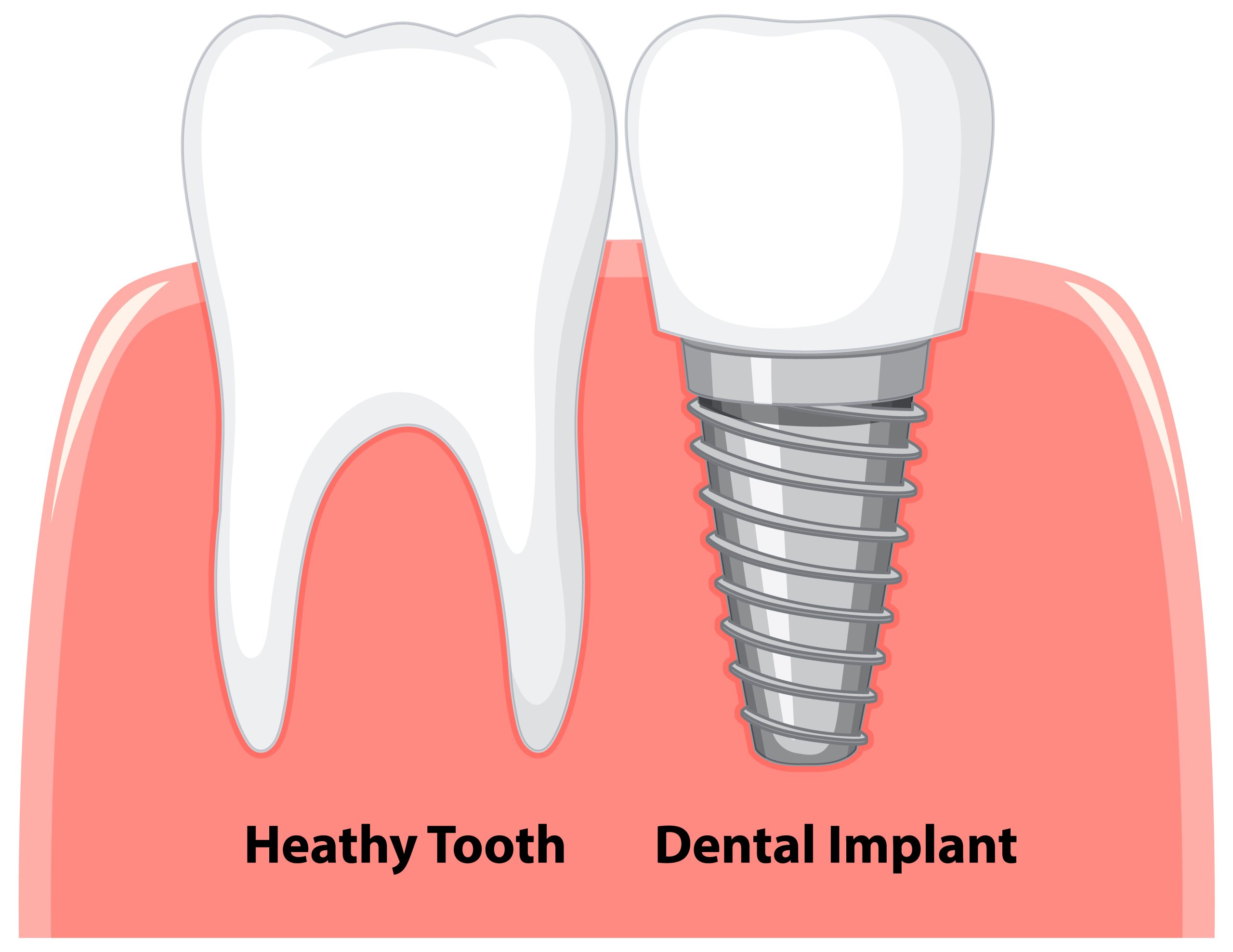How Much Do Dental Implants Cost? | Best Dental