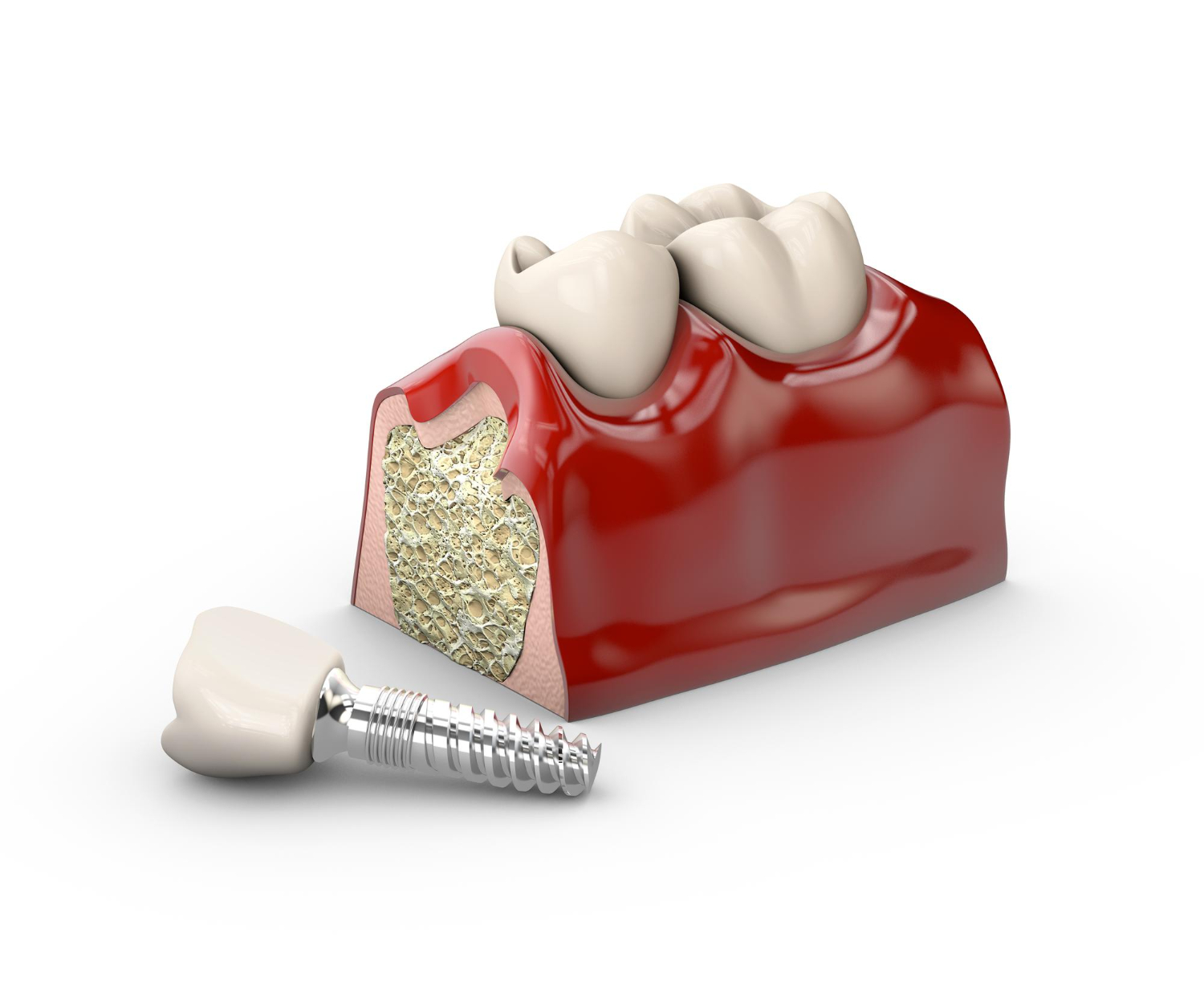 How Much Do Dental Implants Cost? | Best Dental