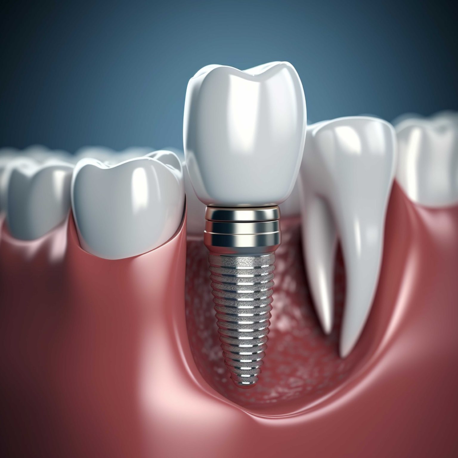 Dental Implants Cost Houston - Best Dental