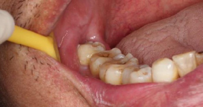 Wisdom Teeth Removal Houston, TX | Best Dental