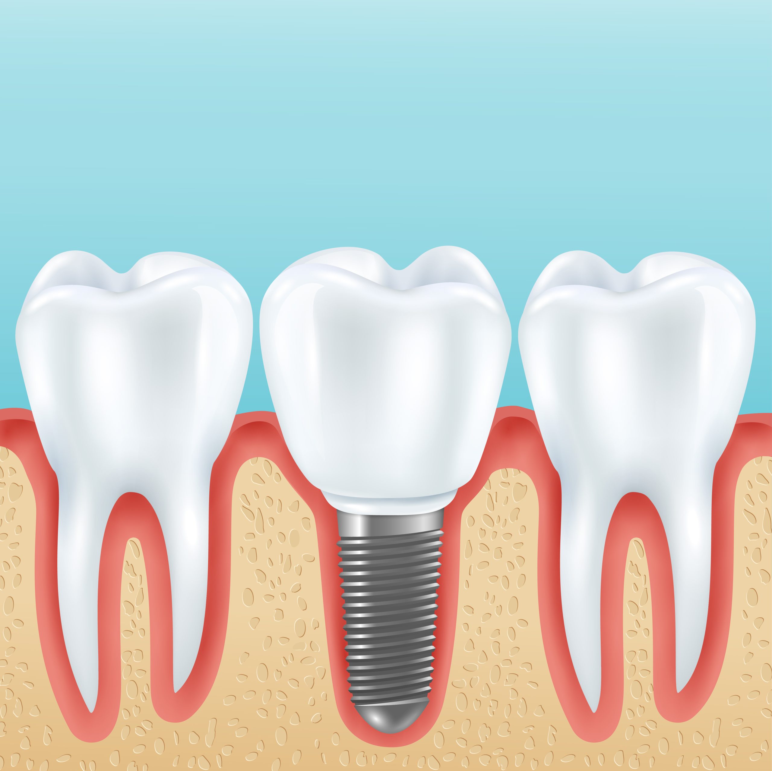How Much Do Dental Implants Cost? | Best Dental