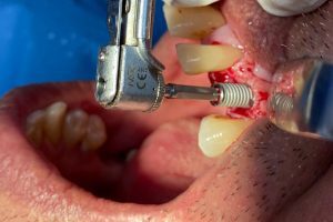 Dental Implant Surgical Placement