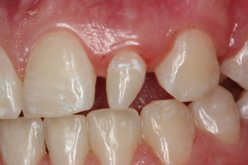Peg Lateral Teeth | Best Dental