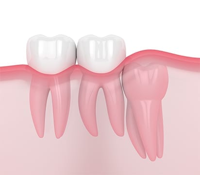 Wisdom Teeth Removal Houston, TX | Best Dental